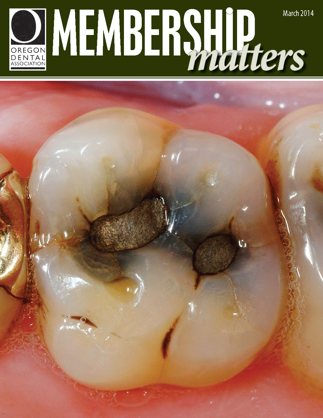 Close-up image of a dental cavity