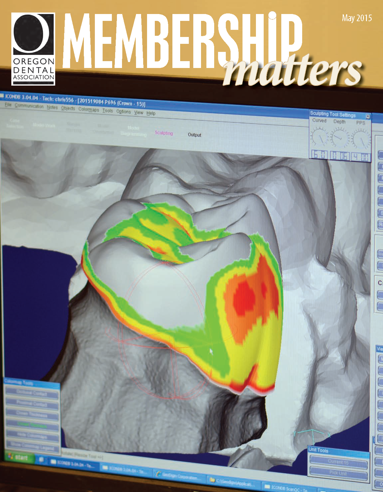 Image of surface enamel of a tooth presented as a 3D model using dental software